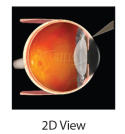 Blumenthal Suturelysis Lens ( VBSL)