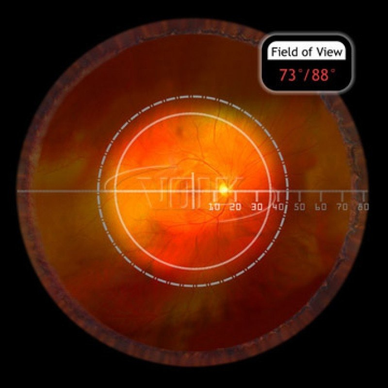Soczewka Central Retinal (VCRLVIT)
