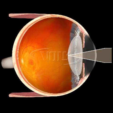 Soczewka jednoraz. Capsulotomy (VCAPS10) Soczewka jednoraz. Capsulotomy (VCAPS10)