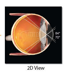Area Centralis® Lens (VAC) VOLK
