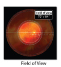 Area Centralis® Lens (VAC) VOLK