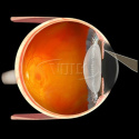 Blumenthal Iridotomy Lens