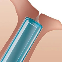 Zatyczki do kanalików łzowych Soft Plug® 0,5/2 mm 2 szt