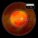 Soczewka Central Retinal ACS® VCRLVITACS