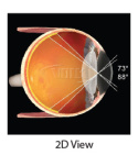 VOLK Central Retinal ACS® autoklaw VCRLVITACS